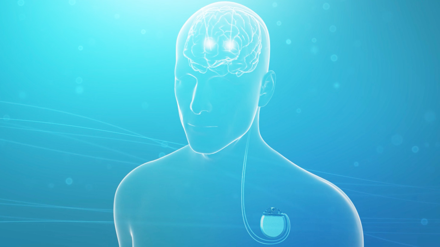 Video over de werking van diepe hersenstimulatie